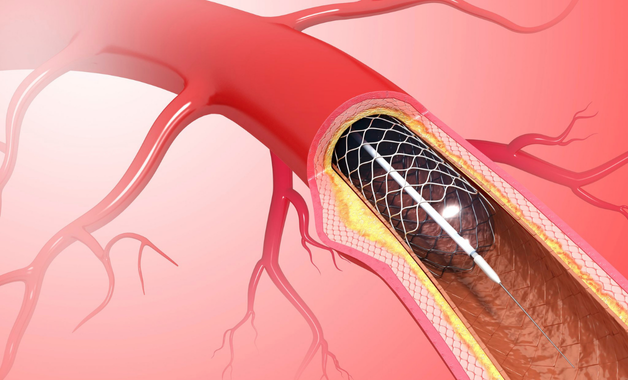 Peripheral Artery Disease